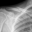 An x-ray showing a broken bone.